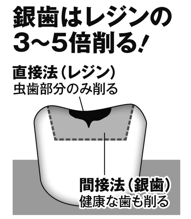 銀歯はレジンの3～5倍削る