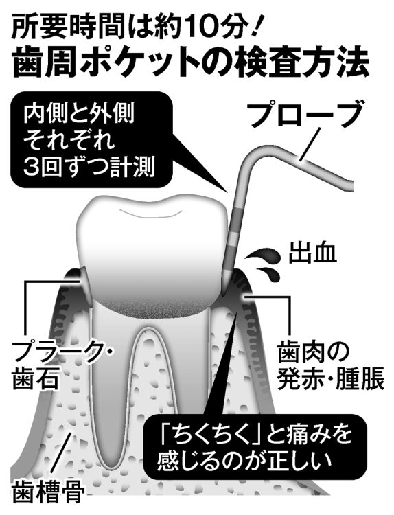 所要時間は10分　歯周ポケットの検査方法