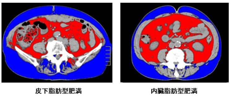 青の部分が皮下脂肪、赤の部分が内臓脂肪