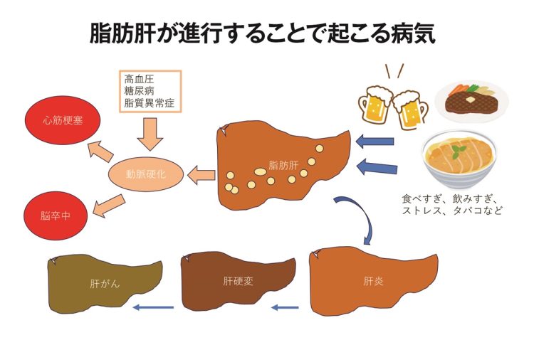 生活習慣から引き起こされる脂肪肝が進行すると様々な病気の原因になる