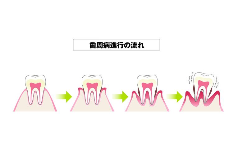 歯周病は成人の歯が抜ける原因の第1位