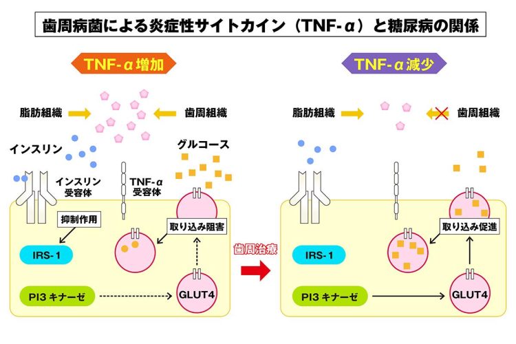 歯周治療でTNF-αが減少すると、より少ないインスリン量でグルコーゲンを取り込めるようになる