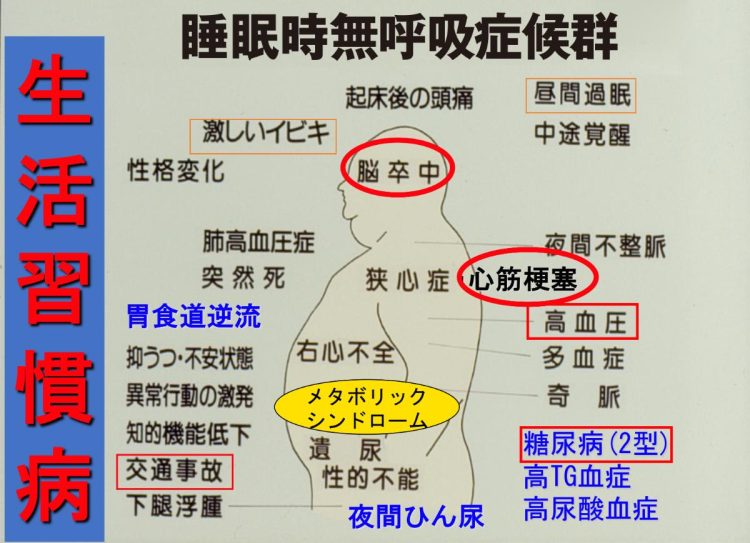 SASと生活習慣病は切り離せない関係がある