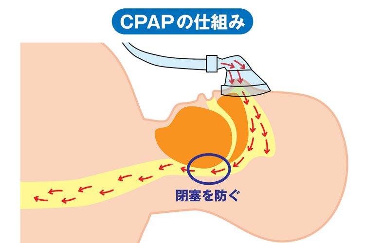 鼻にマスクを装着してCPAP本体から空気を送り込むことで、気道の閉塞を防ぐ