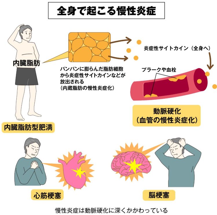 慢性炎症は動脈硬化に深く関わっている