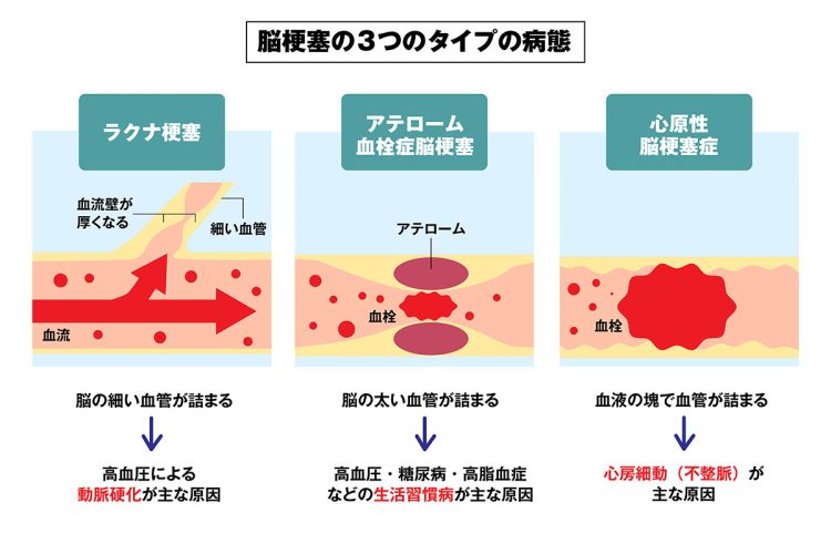 3つのタイプの病態発生頻度は約30％ずつでほぼ同じ割合（イラスト／タナカデザイン）