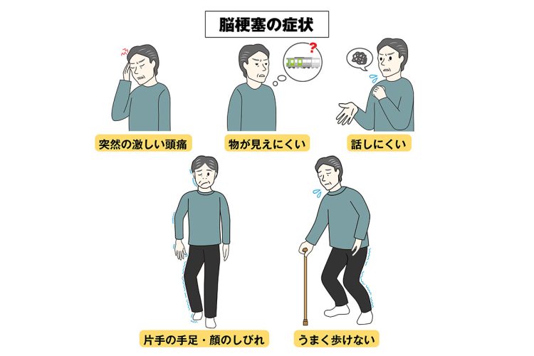 脳梗塞には特徴的な症状がある（イラスト／タナカデザイン）